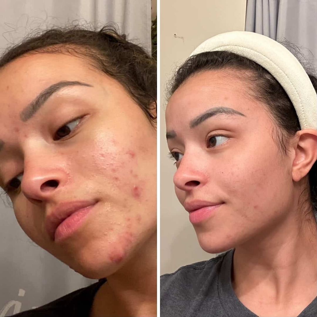 Evatasha Beauty Acne Before & After