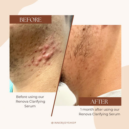  Before and After using Renova Acne Serum